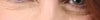 extra skin/crepiness under eyes