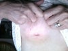 internal sutures keep poking out, surgery done 2009, 2011 problem occurring, mammogram normal