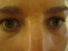 Depressed scar between brows.  Also discolored.  Very annoying.
