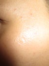 Another depressed scar I've had forever.