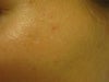 Discoloration around previous depressed scar.