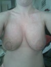 Pls ignore that surgery(its 3 weeks same doctor,and its 2 make them equal.Right breast was much lower than the left one also before augmentation..hhhmmmm I hope they look ok 2 you!?Thank you