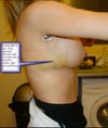 6 Days post op. info on picture
