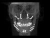 forward CT scan