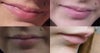 My lip is lumpy on the right side and slants down.