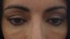 6mos post sculptra