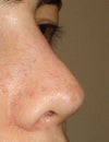 Nose at 2 months post op.