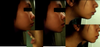 Overbite pictures including comparison between profile & jaw held forward