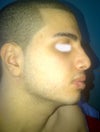 Side view. 13 days post op. Slight supratip swelling. (Had pollybeak removed)