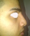 Another side view. 13 days post op. Very slight supratip swelling same place i had pollybeak removed. Why?