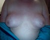 Front view post augmentation and lift
