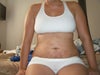 10 days post op.