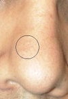 You can see these blackheads follow a formation of the area that was damaged.  They're unnatural because I scarred the area badly myself and I'm worried that they'll never go.  I'm 22 and long past puberty.