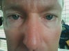 Upper and lower a good idea, but for now could i do lower injections? What other treatments and/or procedures could help my skin significantly?