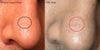 The photo on the left is more recent.  I've had this for many months now and it's well into the healing process but it just doesn't seem to improve anymore.  I just want the discoloration to go and clean pores.