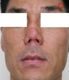 Nose redness