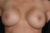 5 months after surgery