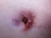 had tummy tuck 2 years ago and this never healed. The area has been larger and it has been smaller.