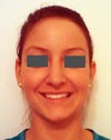 Front- asymmetric chin
