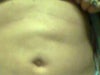 5 weeks after surgery
