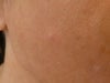 cyst is at center.