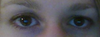 Eye droop 3