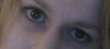 Eye droop 4