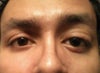 Present scenario_2(I can raise the left eye with effort)