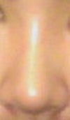 (after surgery at 4 weeks mark) with single source, direct (face-on) lighting.