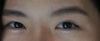 this was my eyes when i didn't had the surgery yet