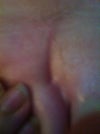 Dimple creating abnormal gluteal fold