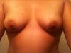 Pre Op front