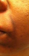 smile lines, discoloured