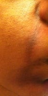 smile lines, discoloured