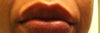smile lines, discoloured
