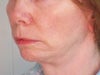 Lower face