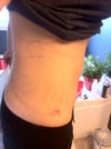 post op 12 hours side 2