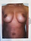 Last pic of 275/270cc Inamed (McGhan)textured saline anatomicals (13 Years)