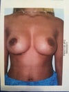 2 weeks post op of new 350cc Mentor moderate plus profile silicone gel