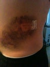 Bruising (6 days after procedure)