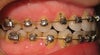 Slight overbite according to ortho.
