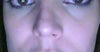 Mid-face flattening -- eyes or cheeks best treated?