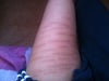 thigh after 6months of receiving treatment.