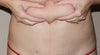 Excess pinched is fat or skin?