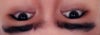 Eye asymmetry