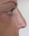 Left Side 6 months post-op