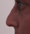 Right Side 6 months post-op