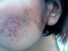 Right cheek