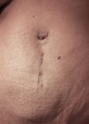 6 months post-op