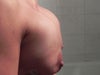 5 days post op